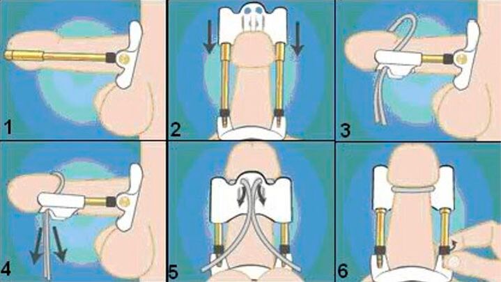 បច្ចេកទេសចុងក្រោយ